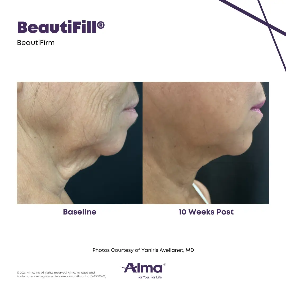 BeautiFill_BA_J
