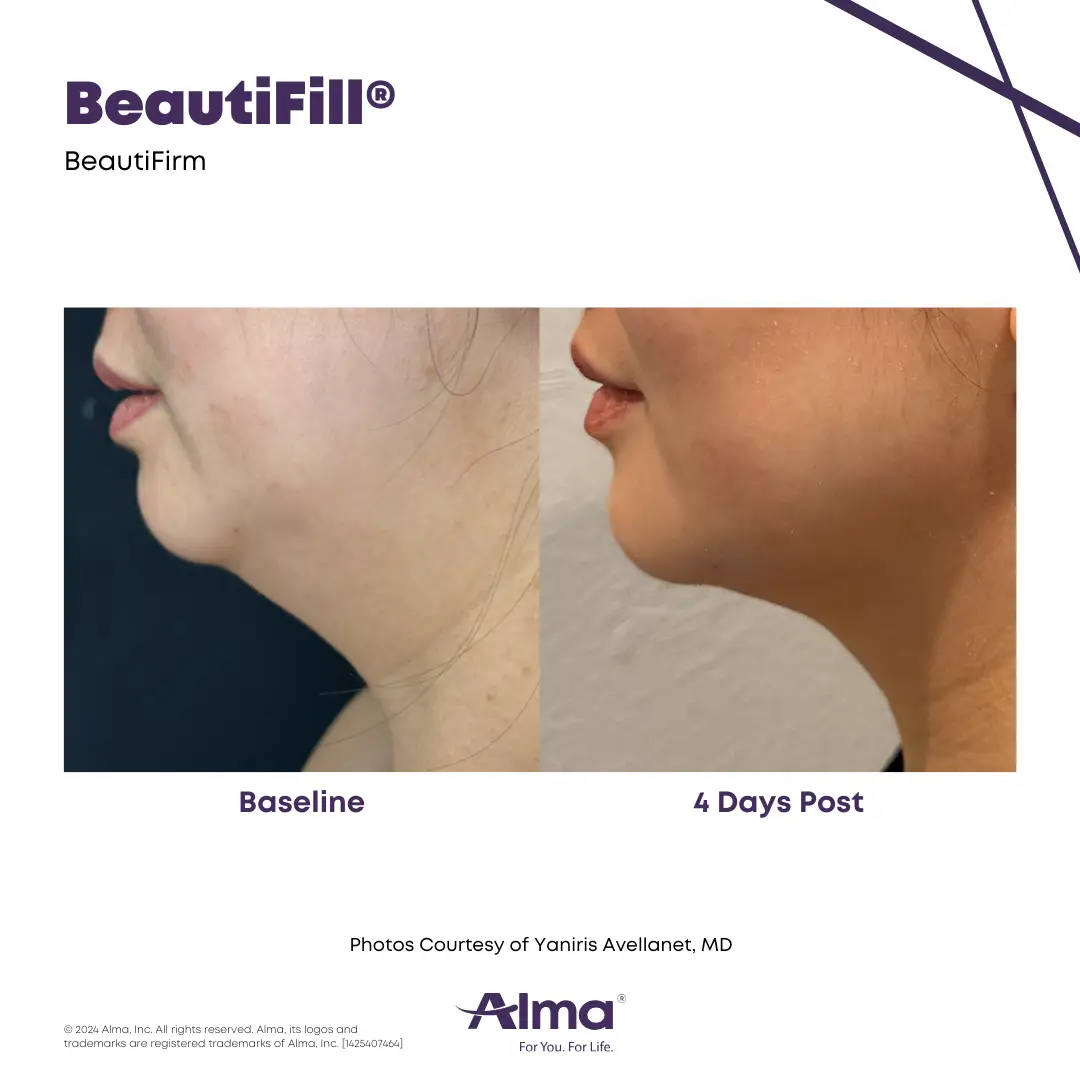 BeautiFill_BA_J