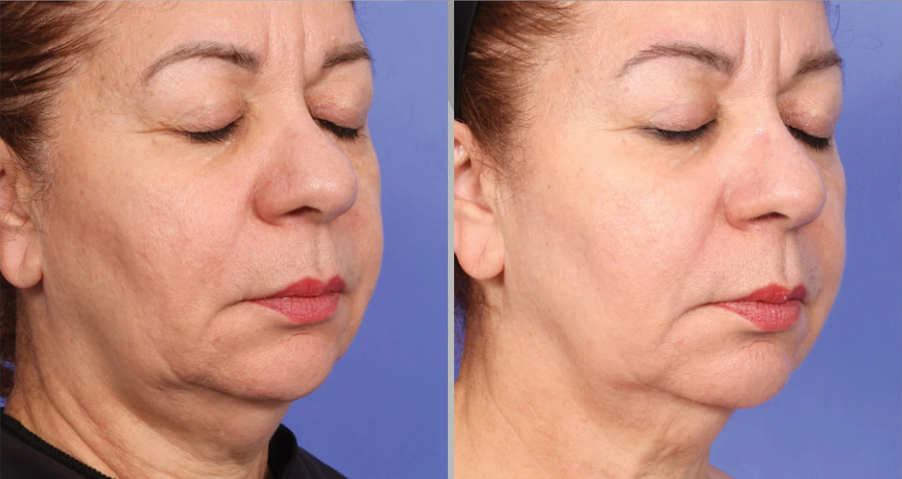 XERF skin tightening before and after &mdash; One Treatment