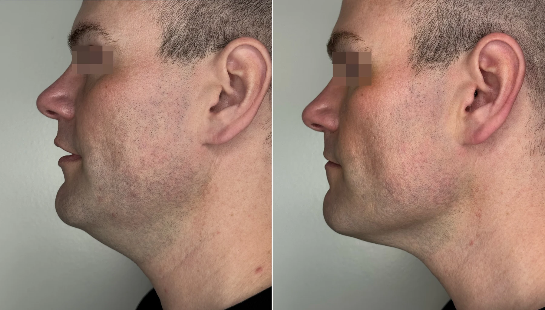 XERF skin tightening before and after &mdash; 2 Months After 2 Treatments