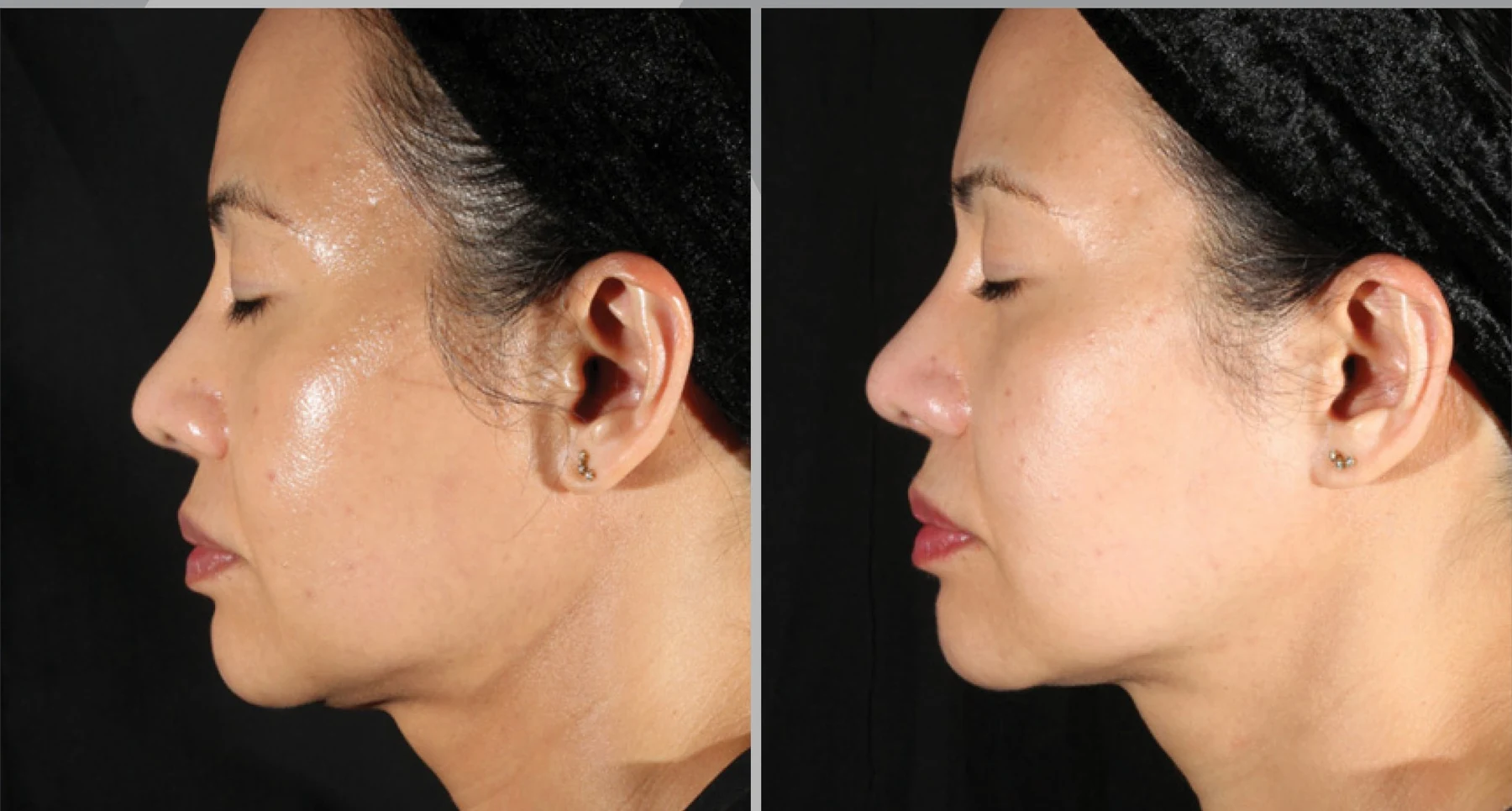 XERF skin tightening before and after &mdash; One Treatment