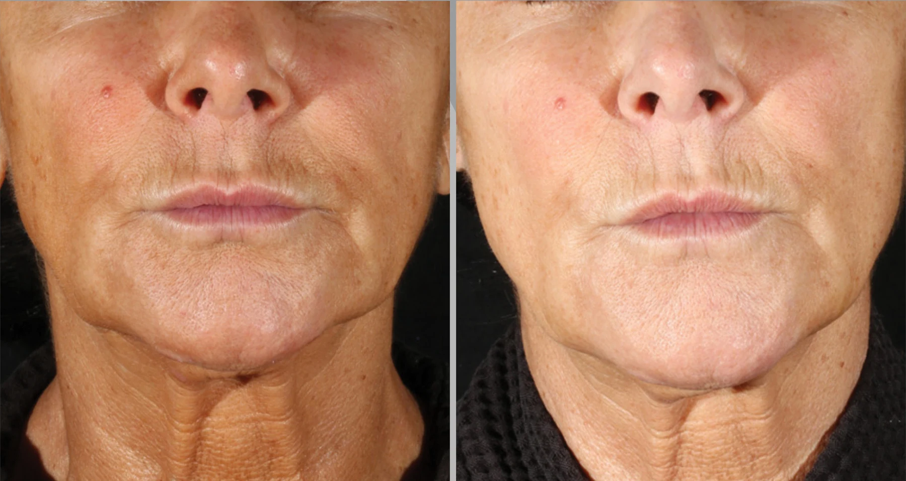 XERF skin tightening before and after &mdash; Two Treatments