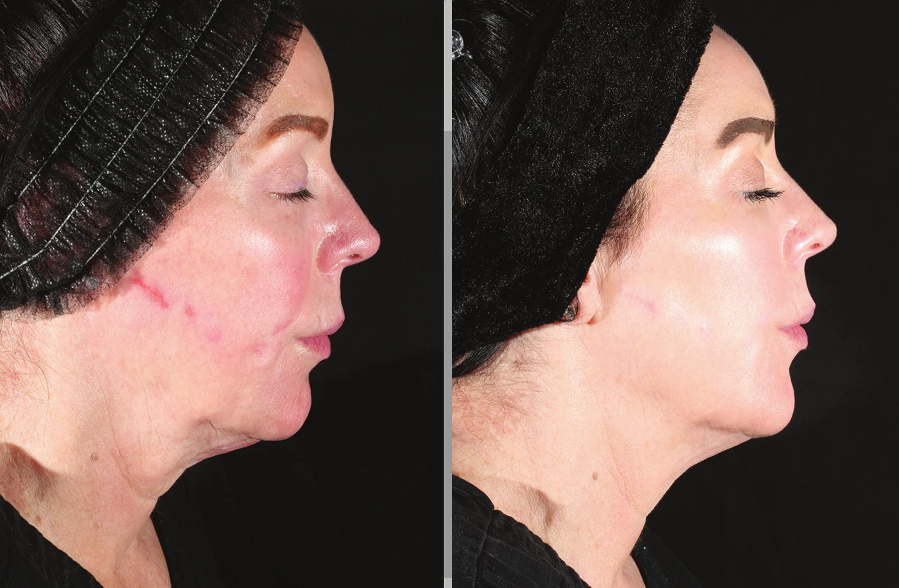 XERF skin tightening before and after &mdash; Two Treatments