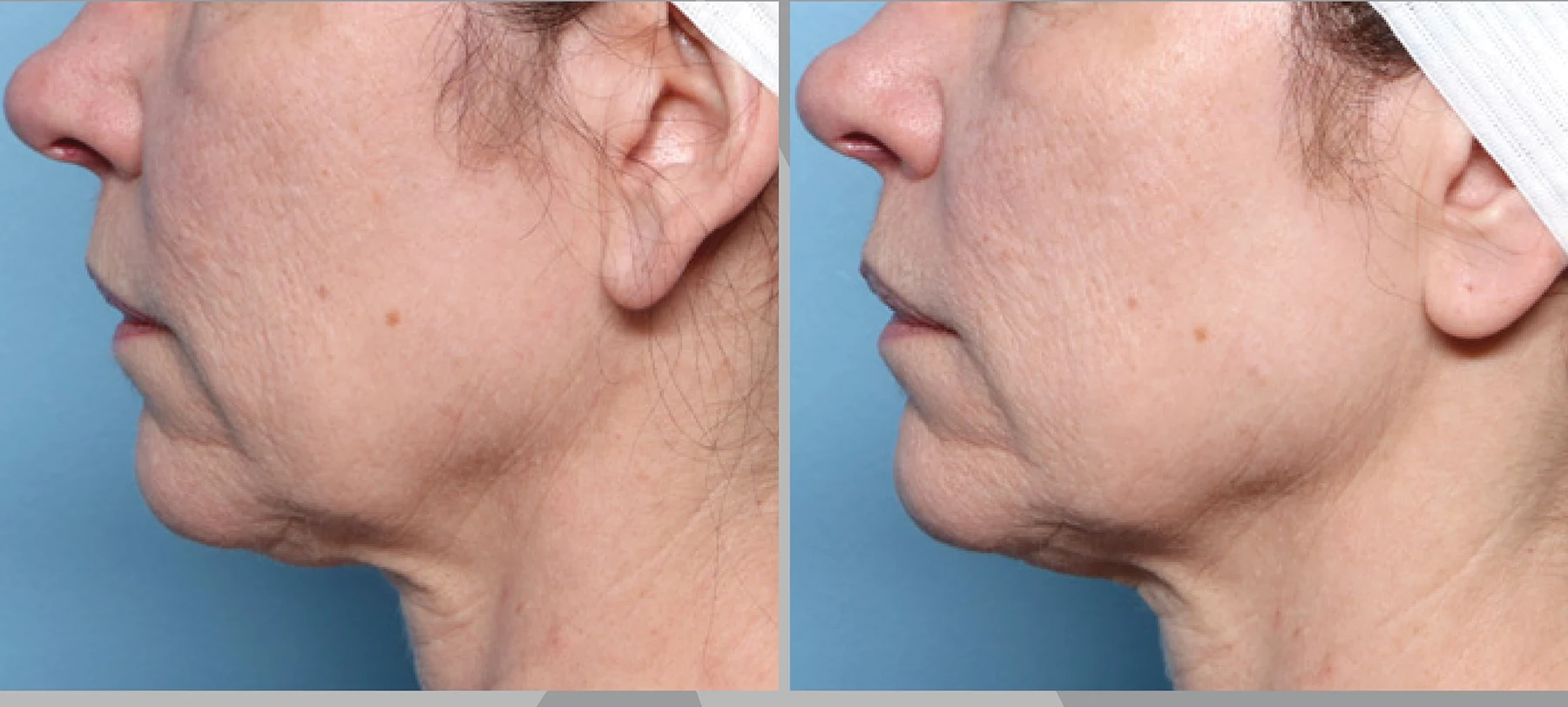 XERF skin tightening before and after &mdash; Two Treatments